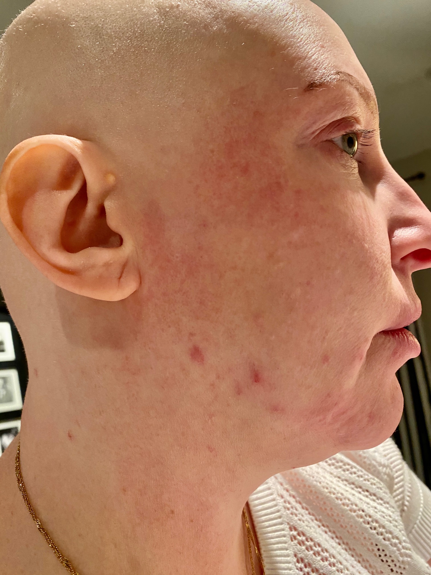 Chemo Skin Bryght 